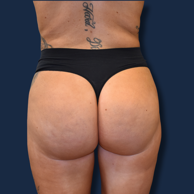 Brazilian Butt Lift after at The Surgeonista - Gina Maccarone MD, FACS in Cincinnati, OH