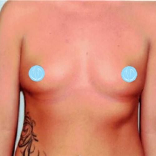 Breast Augmentation before at Dr. Craig Oser in Pittsburgh, PA