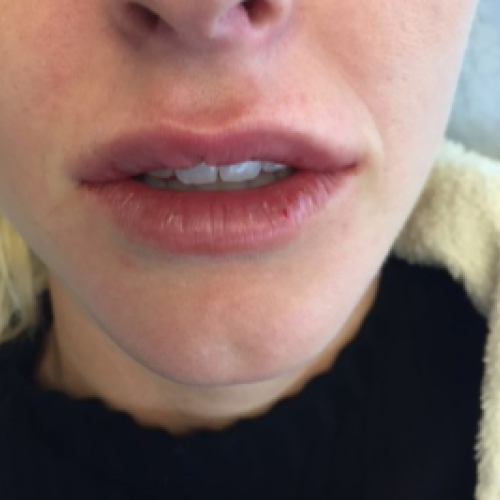 Juvederm after at Dr. Craig Oser in Pittsburgh, PA