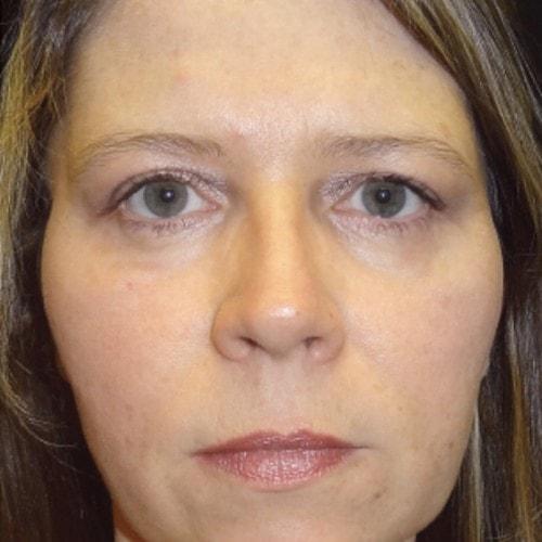 Dr. Craig Oser eyelid lift after — Pittsburgh, PA