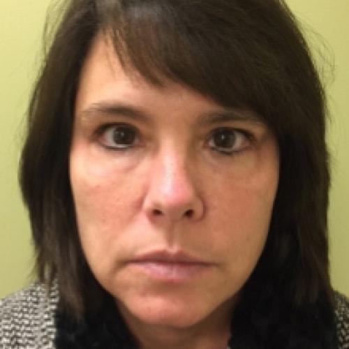 Dr. Craig Oser eyelid lift after — Pittsburgh, PA