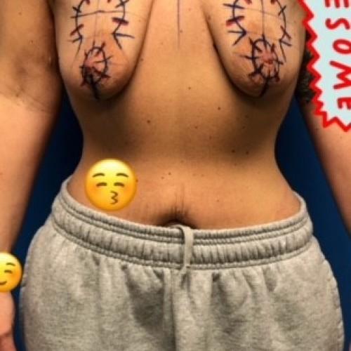Breast Lift result at Dr. Craig Oser in Pittsburgh, PA