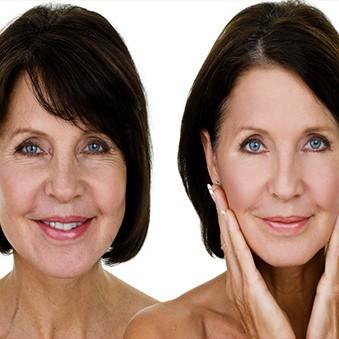 Facelift result at Dr. Craig Oser in Pittsburgh, PA
