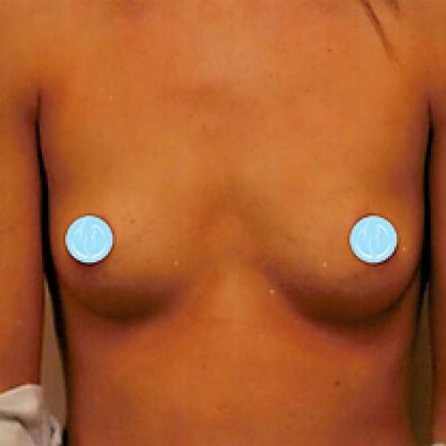 Breast Augmentation before at Dr. Craig Oser in Pittsburgh, PA