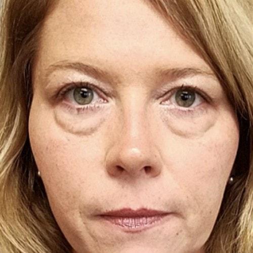 Blepharoplasty before at Dr. Craig Oser in Pittsburgh, PA