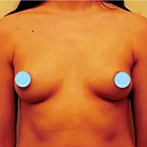Breast Augmentation before at Dr. Craig Oser in Pittsburgh, PA