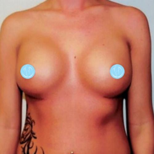 Breast Augmentation after at Dr. Craig Oser in Pittsburgh, PA