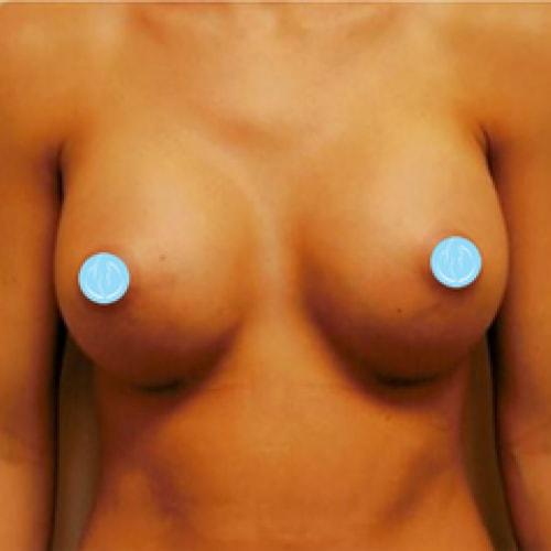 Dr. Craig Oser breast augmentation after — Pittsburgh, PA