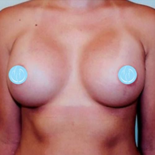Breast Augmentation after at Dr. Craig Oser in Pittsburgh, PA