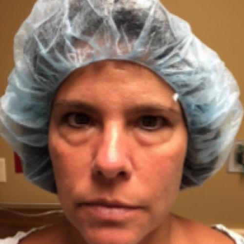 Blepharoplasty before at Dr. Craig Oser in Pittsburgh, PA
