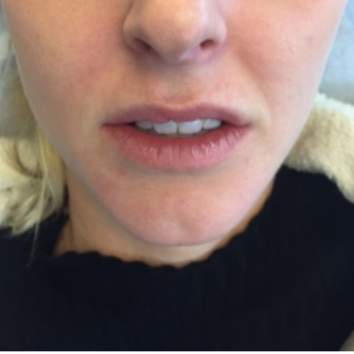 Juvederm before at Dr. Craig Oser in Pittsburgh, PA