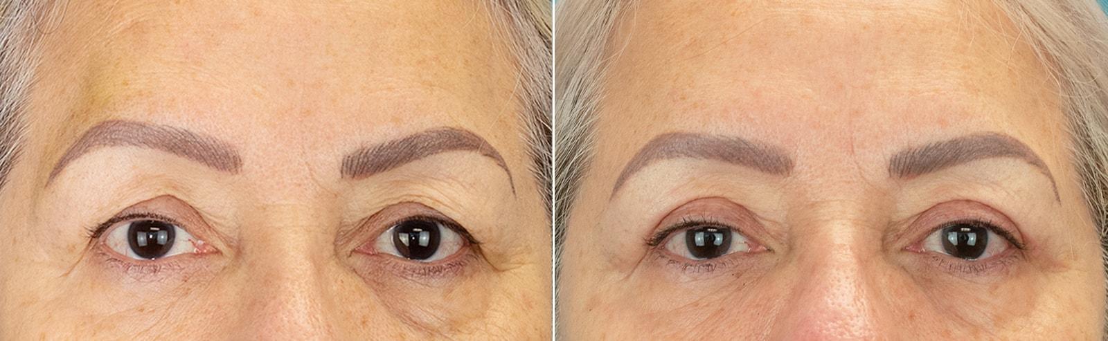 Plastic Surgery of Westchester eyelid lift result — Harrison, NY