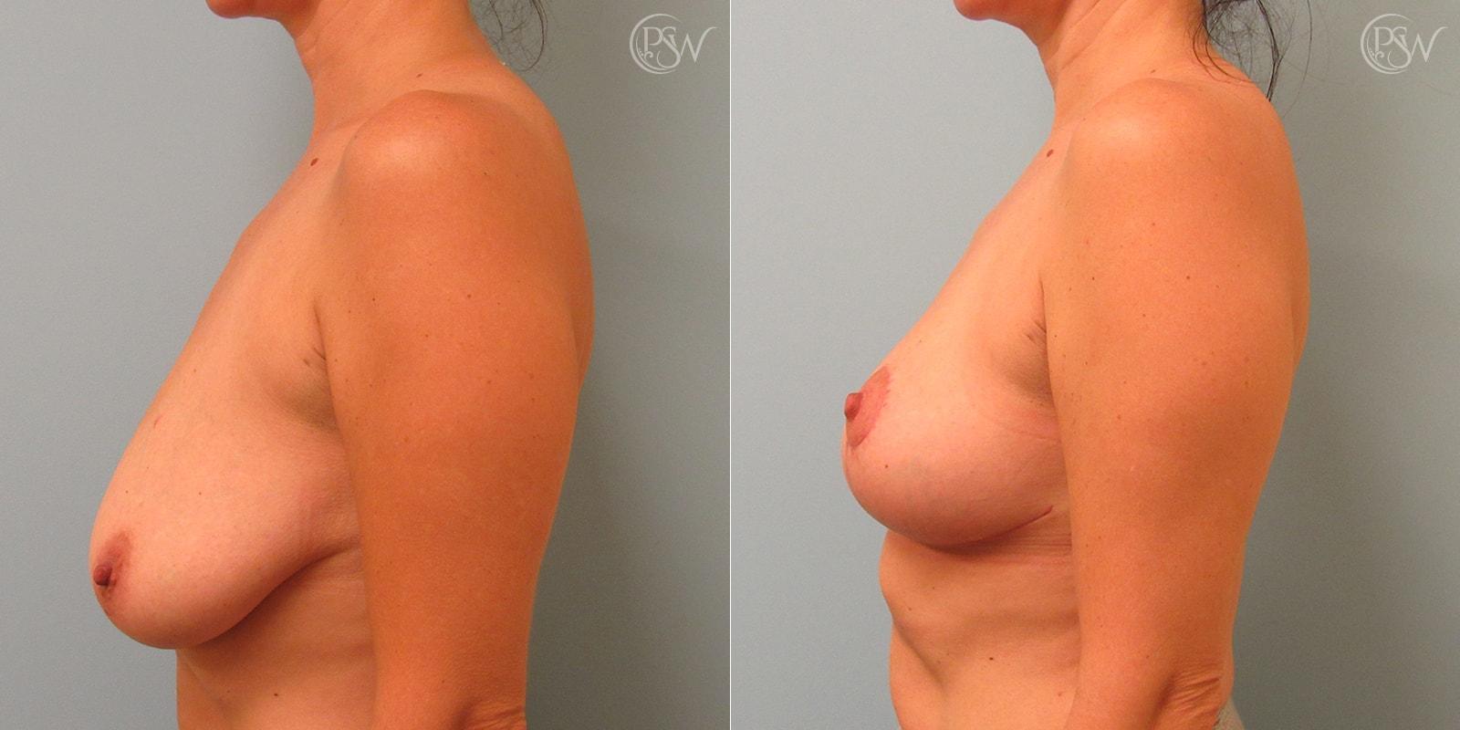 Plastic Surgery of Westchester breast lift result — Harrison, NY