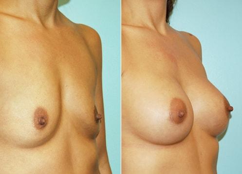 Plastic Surgery of Westchester breast augmentation result — Harrison, NY
