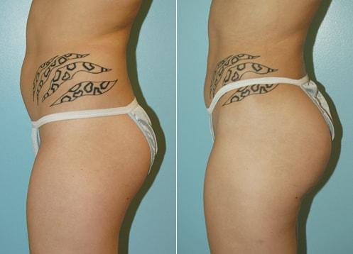 Plastic Surgery of Westchester bbl result — Harrison, NY