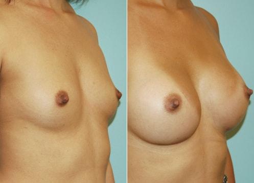 Plastic Surgery of Westchester breast augmentation result — Harrison, NY