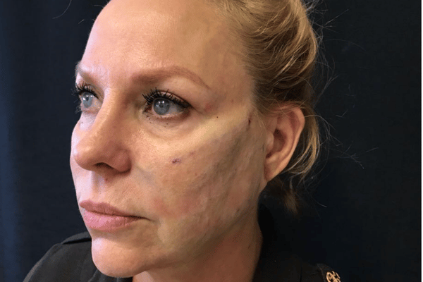 The Institute of Cosmetic Surgery after — Houston, TX
