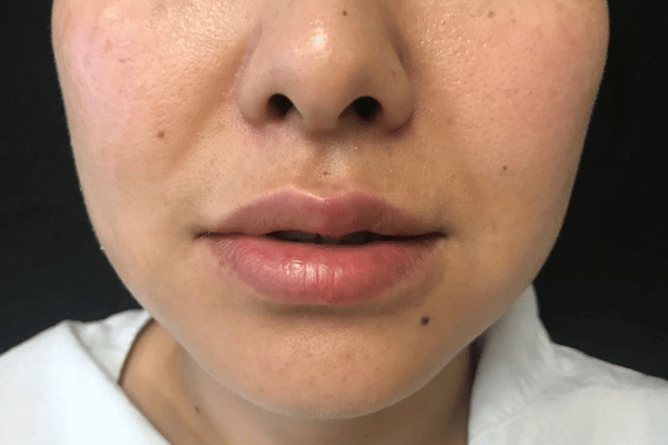 The Institute of Cosmetic Surgery lip filler after — Houston, TX