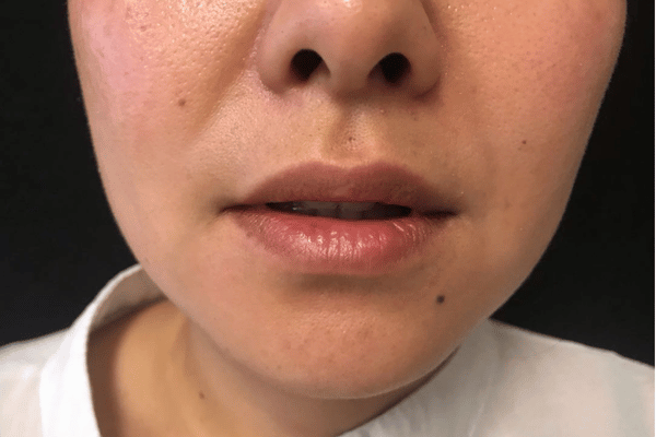 Lip Filler before at The Institute of Cosmetic Surgery in Houston, TX