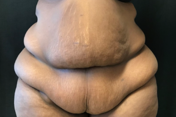 Mini Tummy Tuck before at The Institute of Cosmetic Surgery in Houston, TX