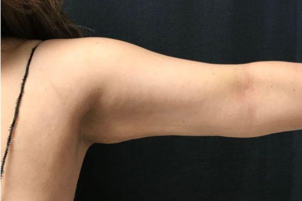 The Institute of Cosmetic Surgery liposuction after — Houston, TX