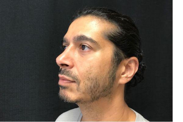 Liquid Rhinoplasty after at The Institute of Cosmetic Surgery in Houston, TX