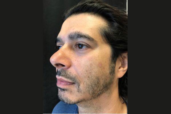 Liquid Rhinoplasty before at The Institute of Cosmetic Surgery in Houston, TX