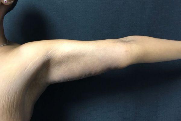 The Institute of Cosmetic Surgery arm lift after — Houston, TX