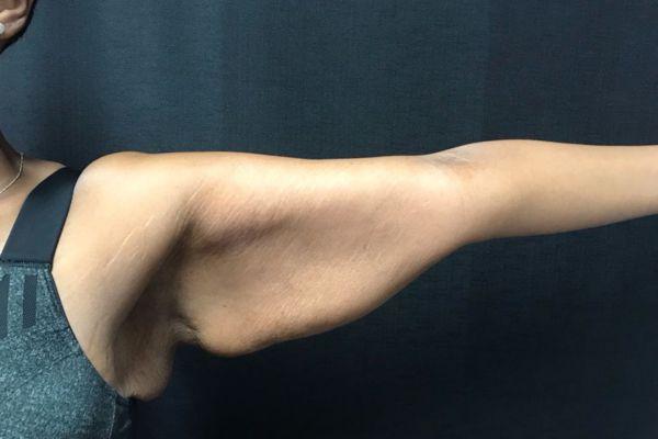 Arm Lift before at The Institute of Cosmetic Surgery in Houston, TX