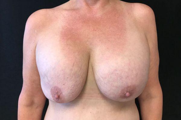 Breast Reduction before at The Institute of Cosmetic Surgery in Houston, TX