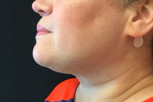 The Institute of Cosmetic Surgery liposuction after — Houston, TX