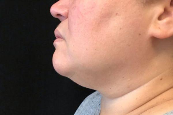 Liposuction before at The Institute of Cosmetic Surgery in Houston, TX