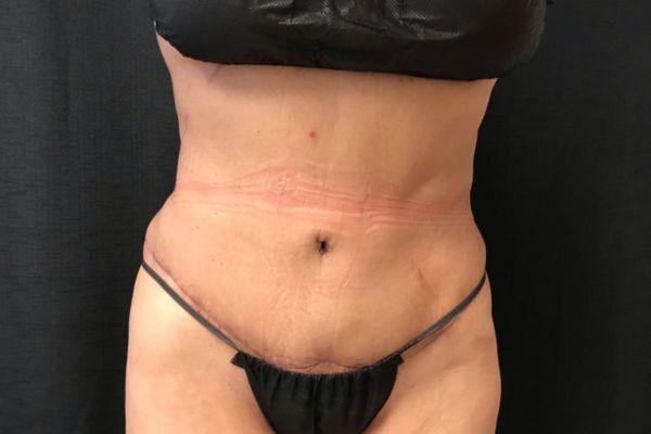 The Institute of Cosmetic Surgery tummy tuck after — Houston, TX