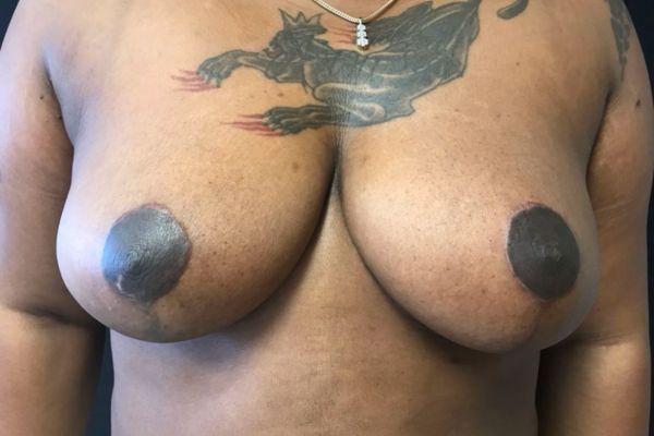 Breast Reduction after at The Institute of Cosmetic Surgery in Houston, TX