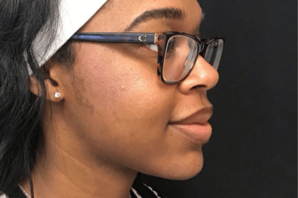 The Institute of Cosmetic Surgery after — Houston, TX