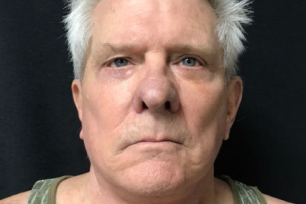 The Institute of Cosmetic Surgery after — Houston, TX