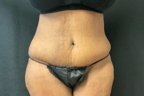The Institute of Cosmetic Surgery tummy tuck after — Houston, TX