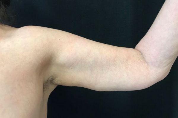 Arm Lift after at The Institute of Cosmetic Surgery in Houston, TX