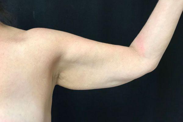 Arm Lift before at The Institute of Cosmetic Surgery in Houston, TX