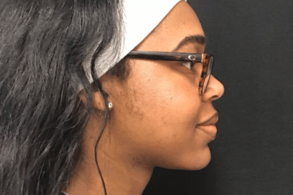 The Institute of Cosmetic Surgery after — Houston, TX
