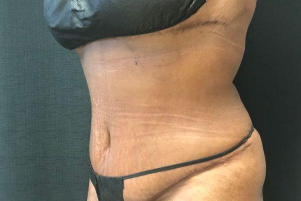 The Institute of Cosmetic Surgery tummy tuck after — Houston, TX