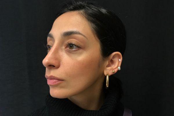 The Institute of Cosmetic Surgery rhinoplasty after — Houston, TX