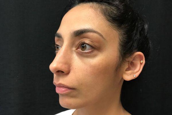 Liquid Rhinoplasty before at The Institute of Cosmetic Surgery in Houston, TX