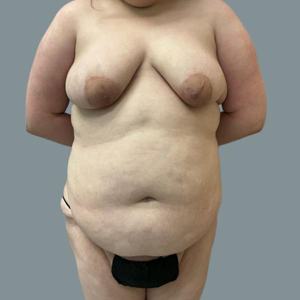 Tummy Tuck before at La Femme Plastic Surgery in Las Vegas, NV