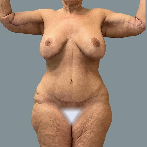 Tummy Tuck after at La Femme Plastic Surgery in Las Vegas, NV