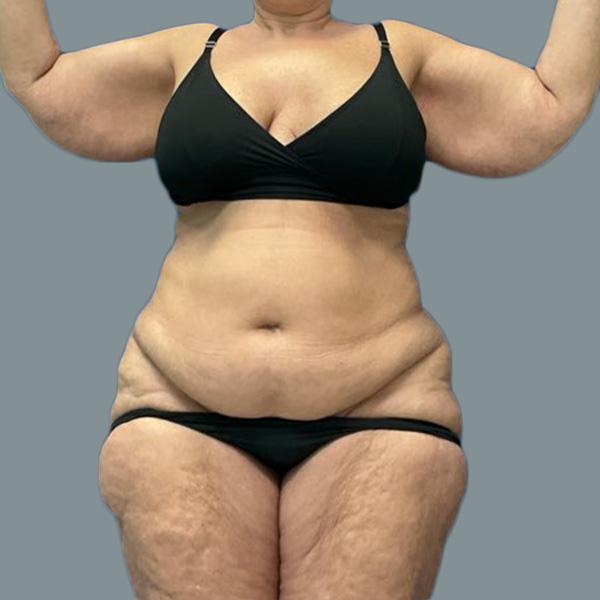 Tummy Tuck before at La Femme Plastic Surgery in Las Vegas, NV