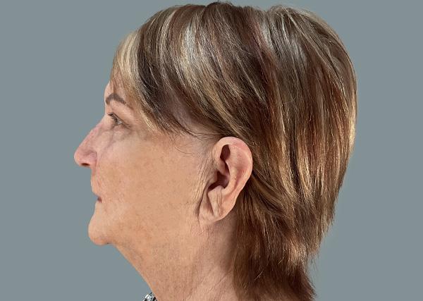 Blepharoplasty after at La Femme Plastic Surgery in Las Vegas, NV