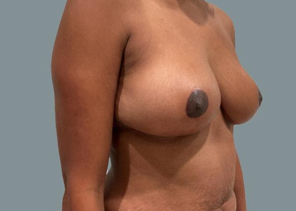 La Femme Plastic Surgery breast reduction after — Las Vegas, NV