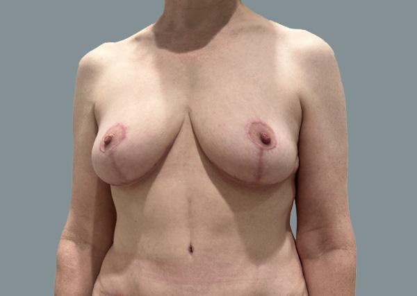 Breast Lift after at La Femme Plastic Surgery in Las Vegas, NV