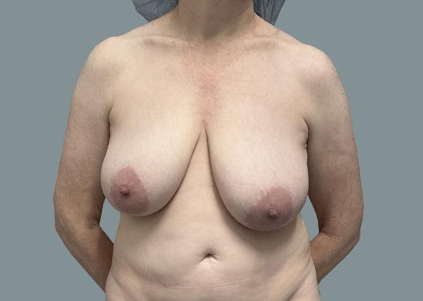 Breast Lift before at La Femme Plastic Surgery in Las Vegas, NV